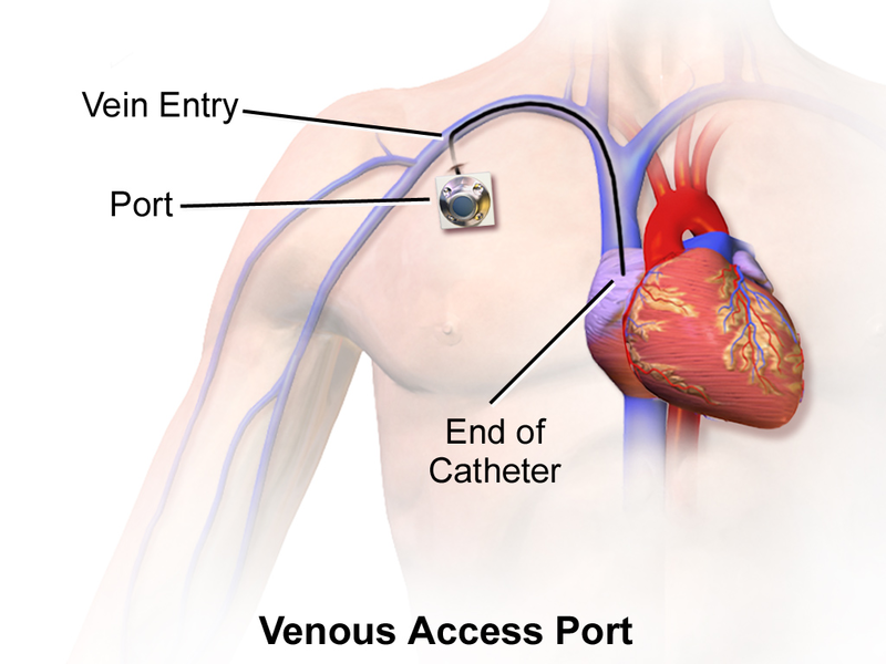 Illustration showing Implanted Venous Access Port, with textual labels