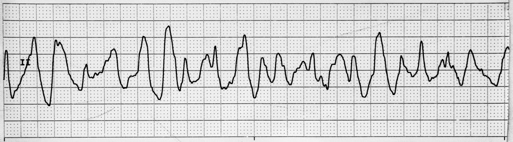 Image showing Ventricular Fibrillation on an ECG