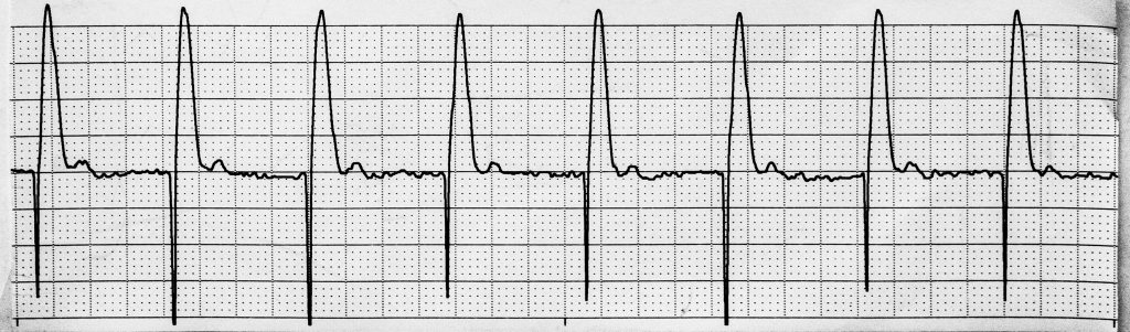 Image showing ventricular paced rhythm in an ECG