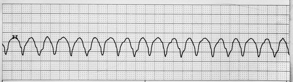 Image showing Ventricular Tachycardia on an ECG