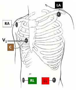 Image showing Electrode Placement for Telemetry