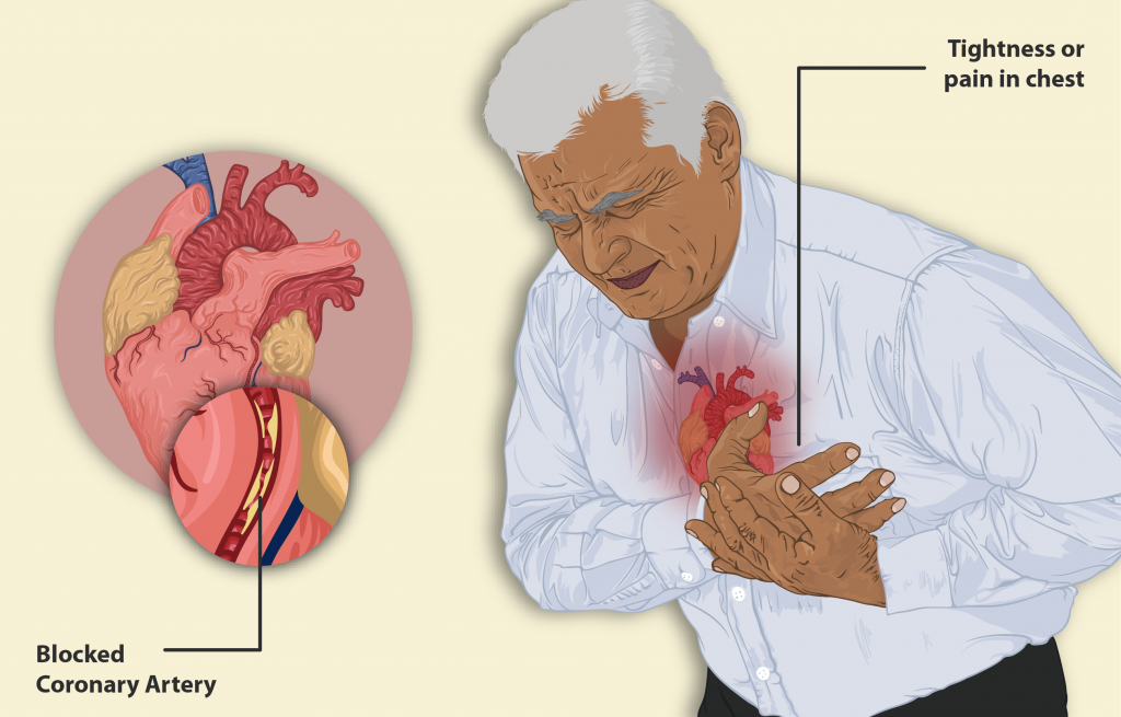 Illustration showing a person experiencing a myocardial infarction, with closeup of blocked coronary artery