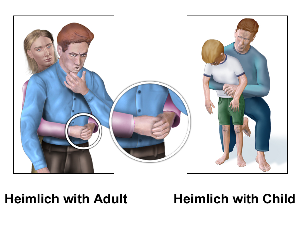 Illustrations demonstrating administration of Heimlich maneuver on an adult and a child