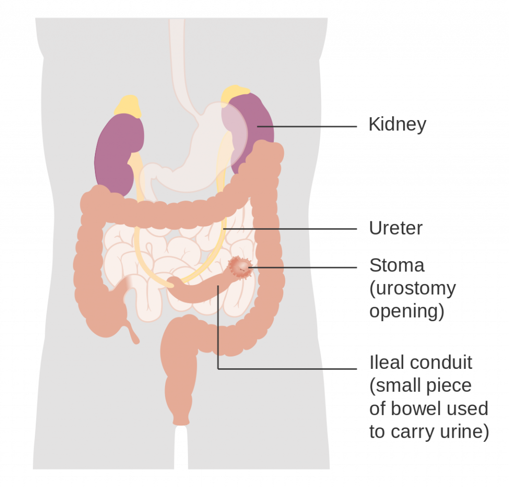 Diagram showing how a urostomy is made, with textual labels