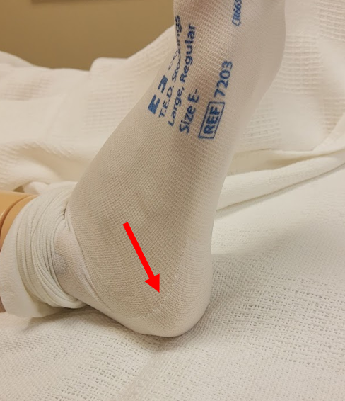 Photo showing how to Ensure Proper Placement of Heel Marker on Heel