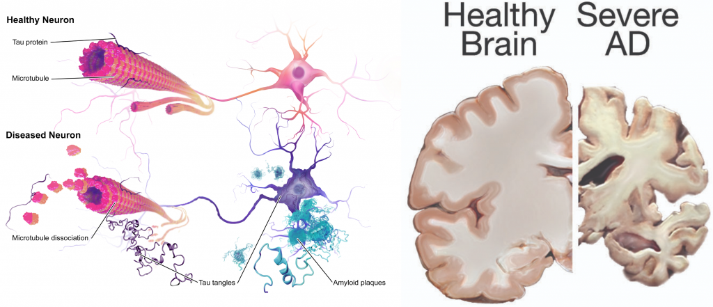 Illustrations showing Changes in Neurons and the Brain Caused by Alzheimer’s Disease