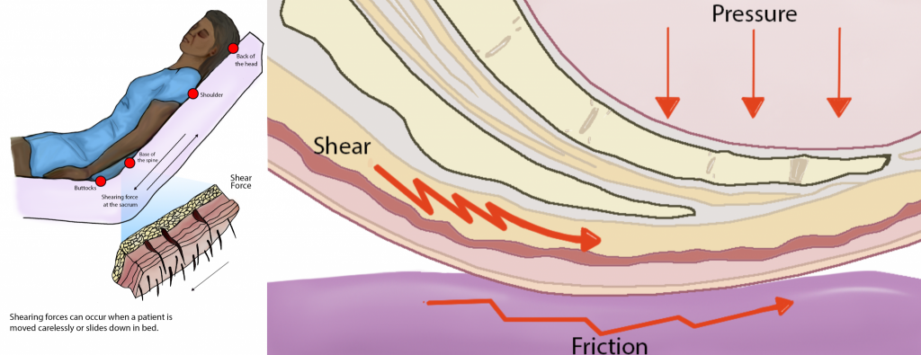 Illustration showing development of pressure injuries