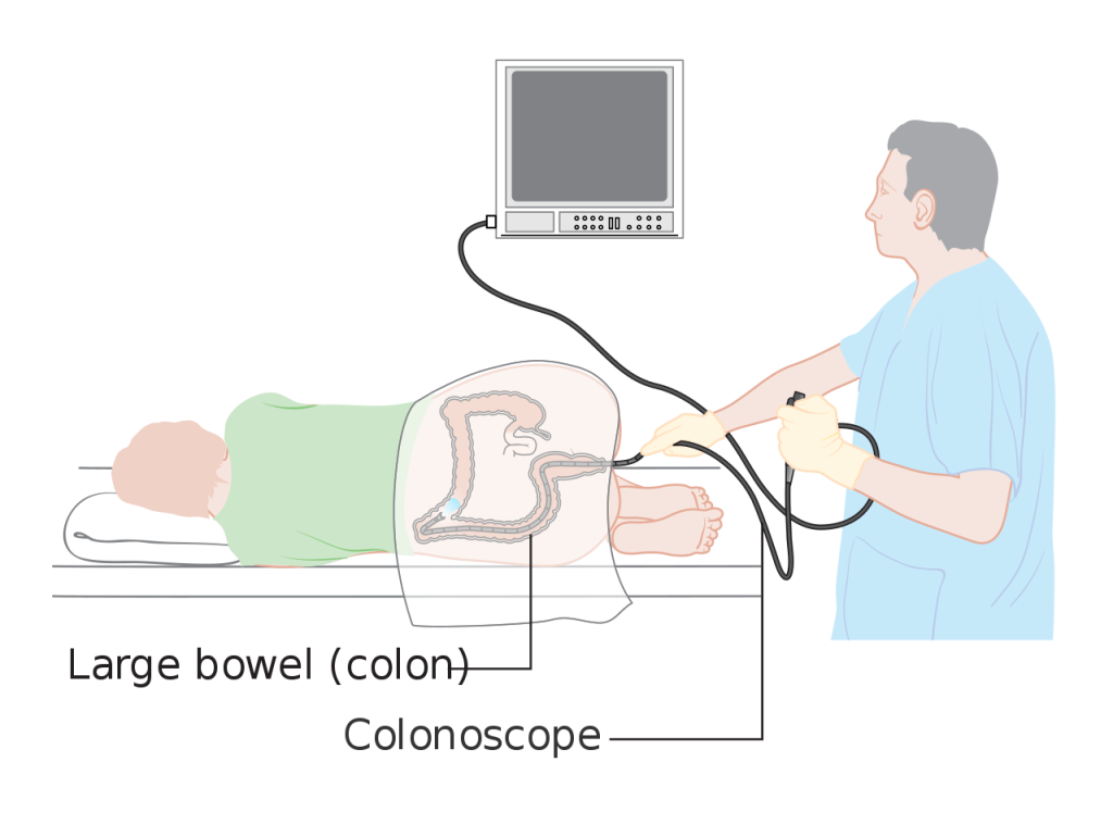 Illustration showing a colonoscopy procedure with labels for large bowel and colonoscope