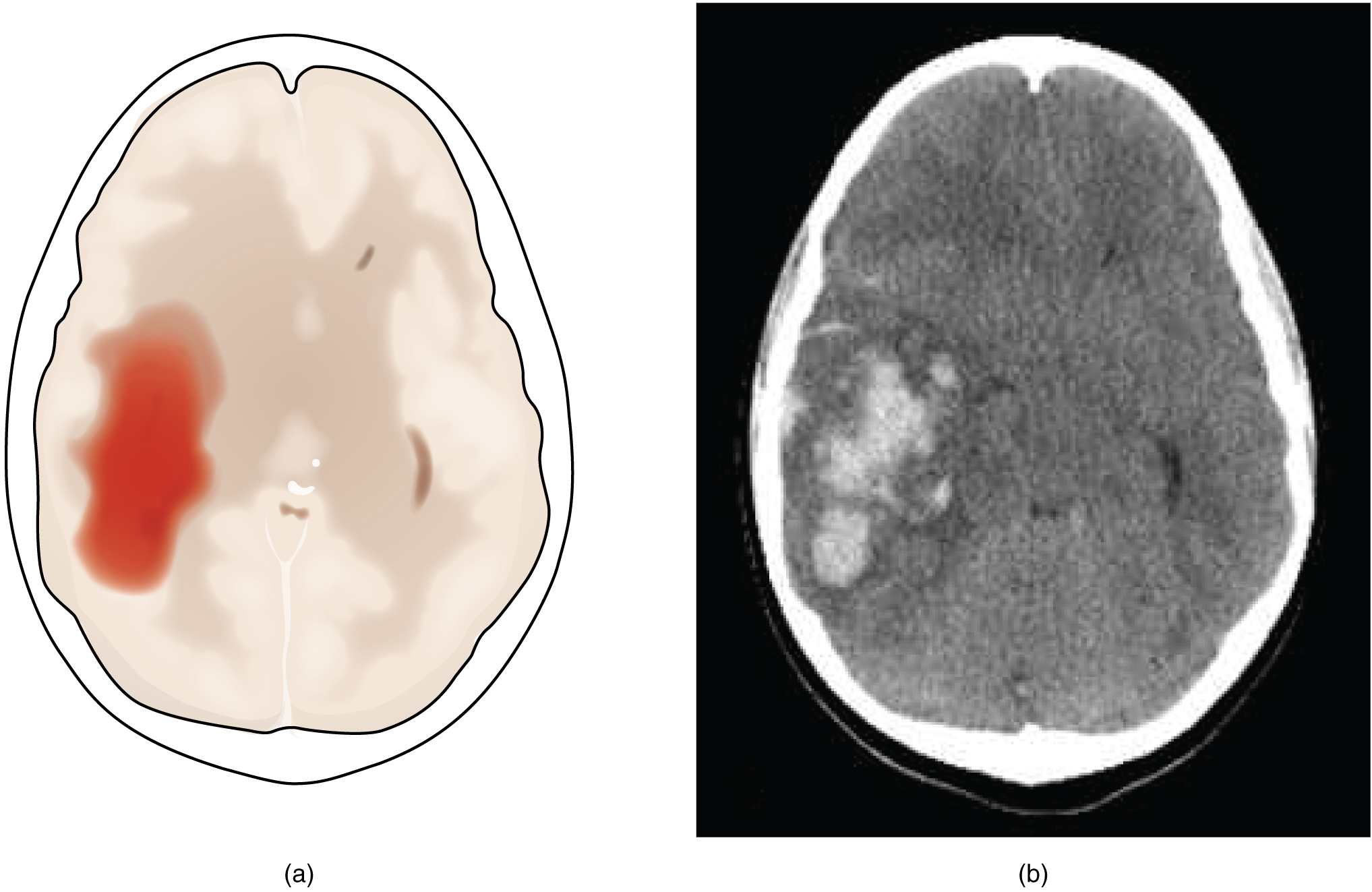 Image showing impact area of Hemorrhagic Stroke on the brain