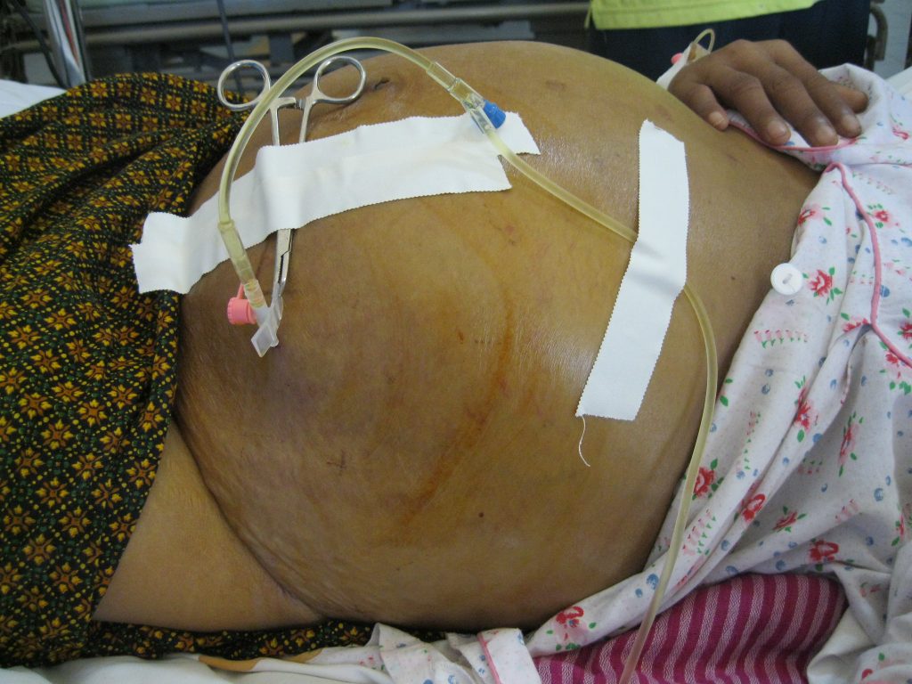 Image showing ascites in a patient