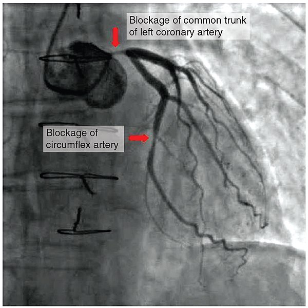 Image showing Angiogram of Atherosclerotic Coronary Arteries