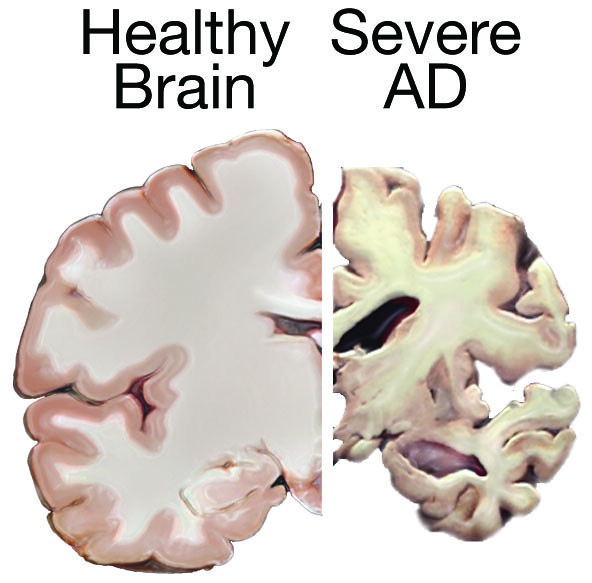 Image showing a Comparison of Healthy Brain Tissue to Severe Alzheimer’s Disease