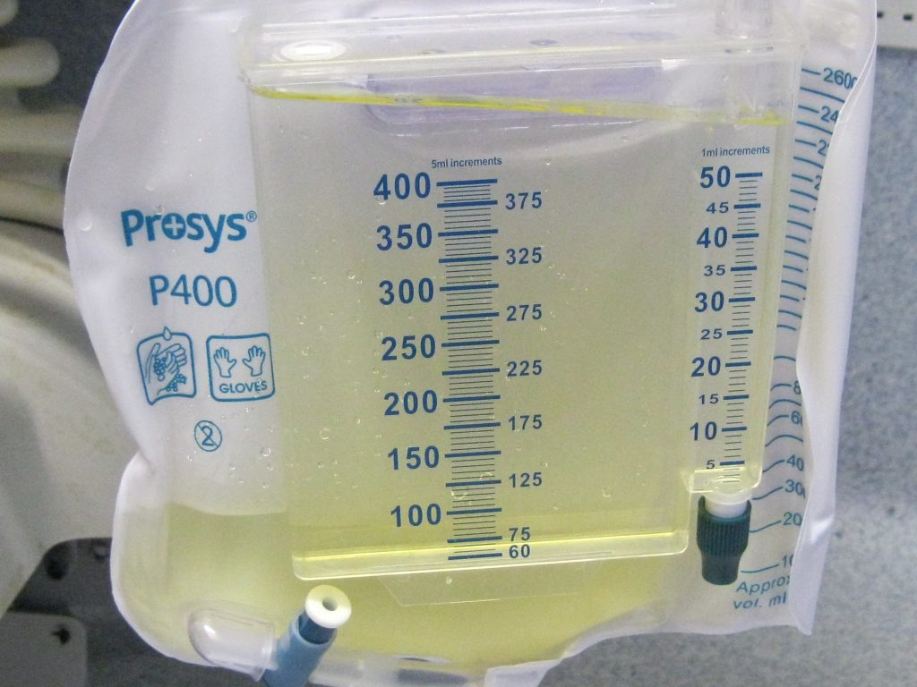 Image showing Dilute Urine Seen in Polyuria