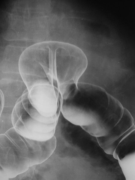 X ray image showing Barium Enema to show a Colon Herniation