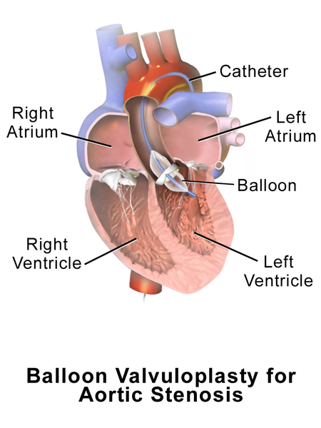 Illustration of Valvuloplasty with labels