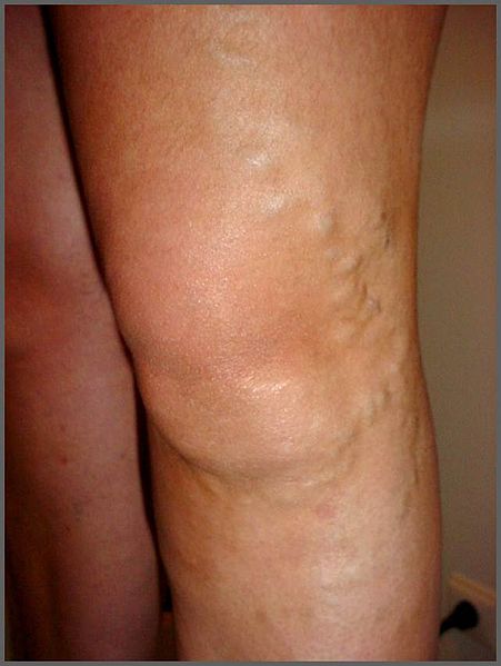 Image showing varicose veins on a person's leg