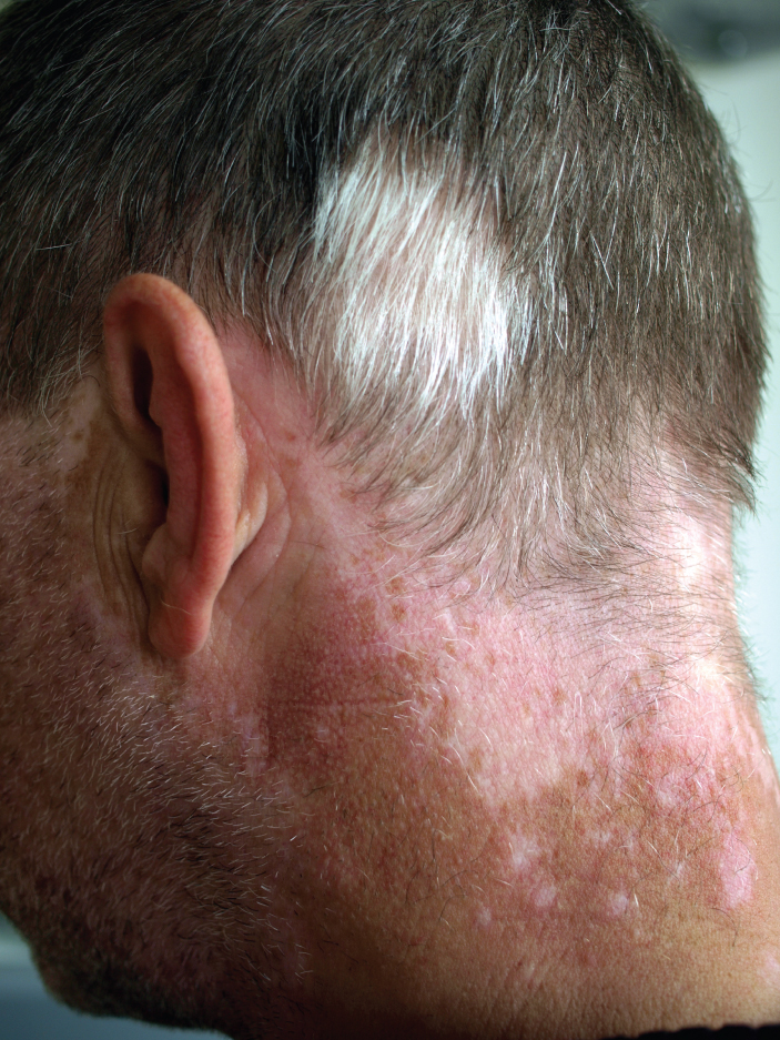 Photo showing vitiligo on the back of the head and neck of an individual