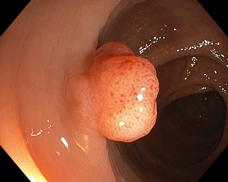 Image showing a colon polyp