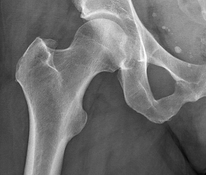 Image showing a normal hip x-ray