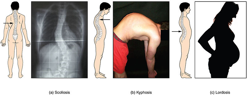 Images showing Abnormal Curvatures of the Vertebral Column, including Scoliosis, Kyphosis, & Lordosis