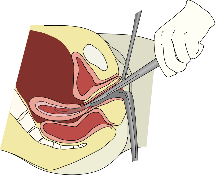 Illustration showing a D and C procedure