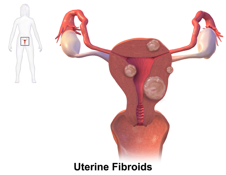 Illustration showing locations of Uterine Fibroids both within a female figure and on a closeup of the female reproductive organs