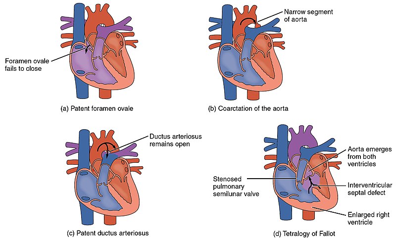 Illustration showing Examples of Congenital Heart Disorders with labels for major parts