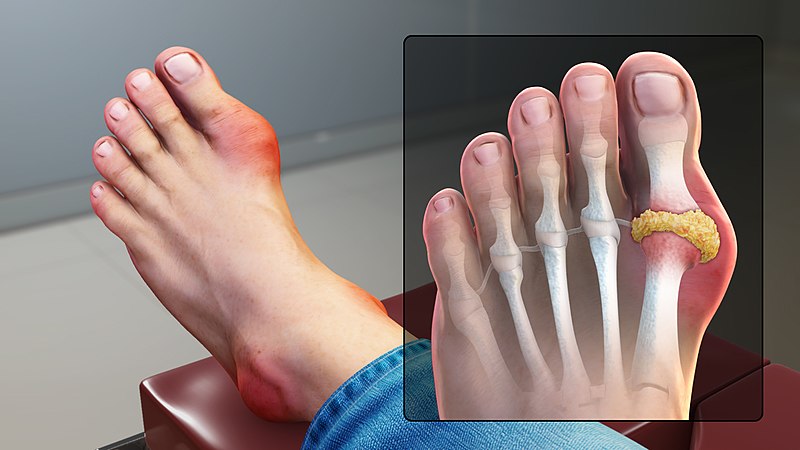 Images showing impact of gout on big toe joint