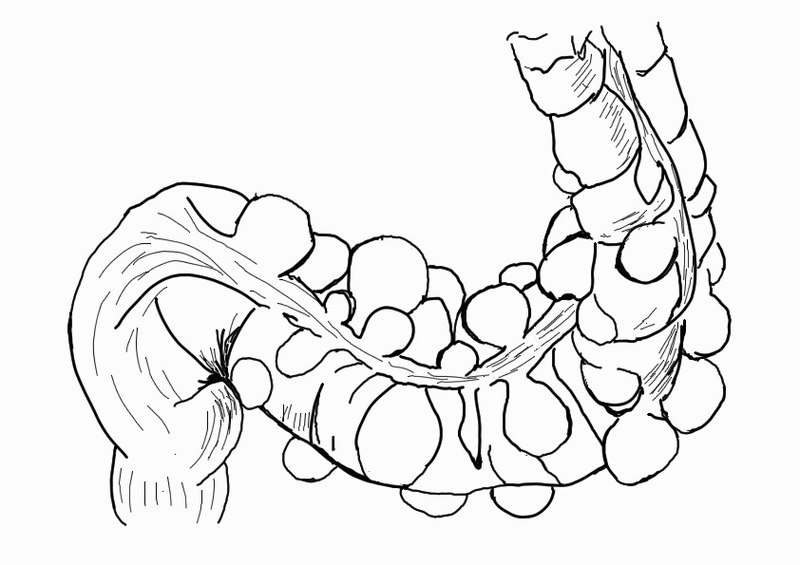 Illustration of diverticulosis