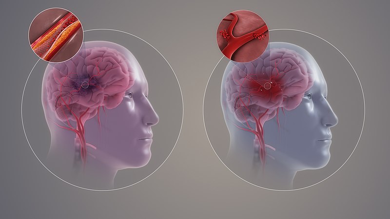 Image showing a Comparison of Ischemia and Hemorrhagic Strokes