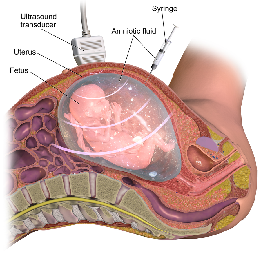 Illustration showing amniocentesis procedure, with textual labels