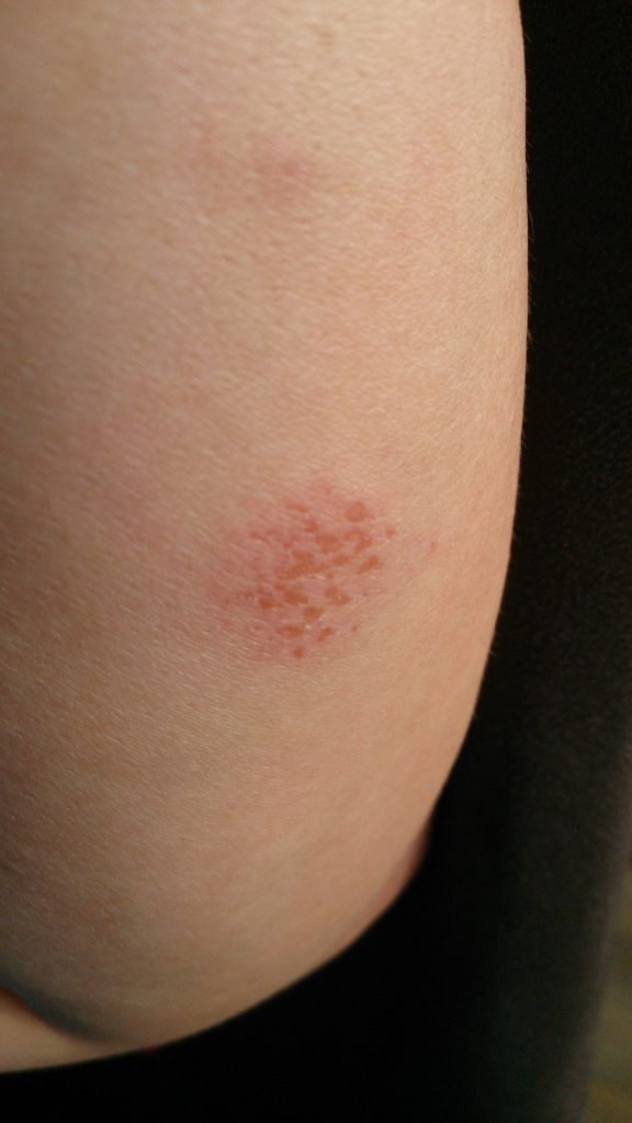 Photo showing an abrasion on the back of an arm