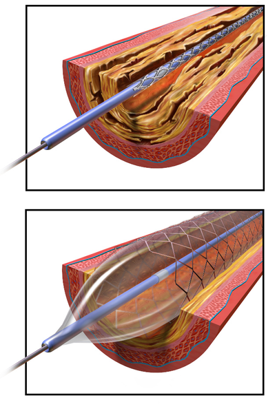 Illustration showing Angioplasty with Stent Placement