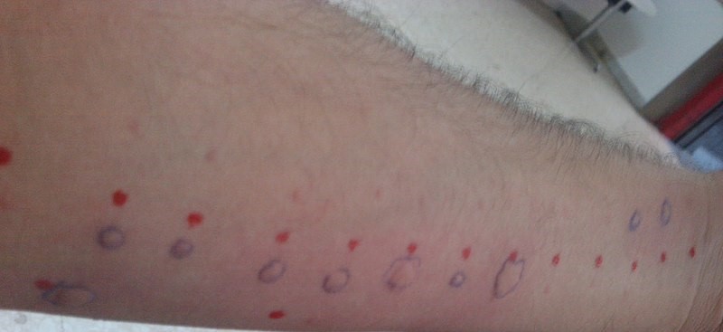 Photo showing allergy testing marks on a patient's arm