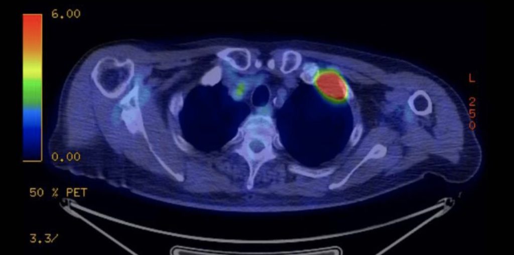 Image showing a PET-CT Scan
