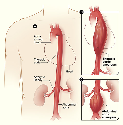 Illustration showing Thoracic and Abdominal Aneurysms in a human torso, with labels