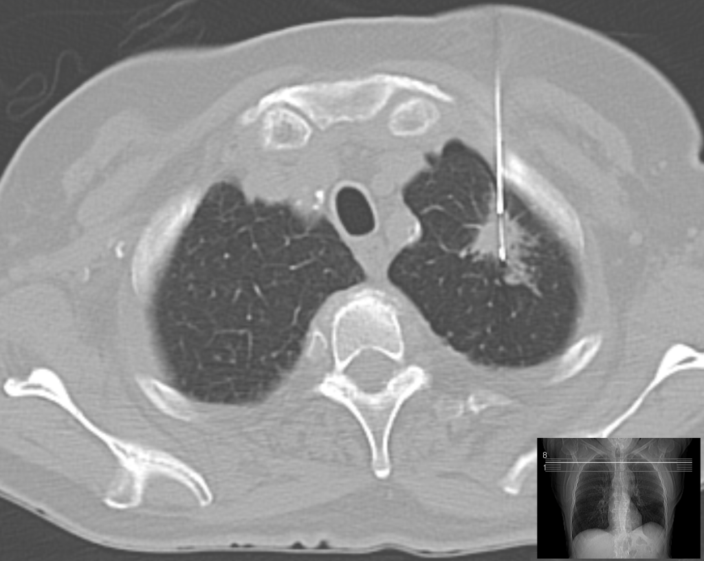 Image showing a CT-guided needle biopsy of the lung