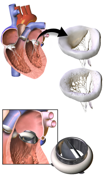 Illustration showing Valve Replacement With a Mechanical Valve