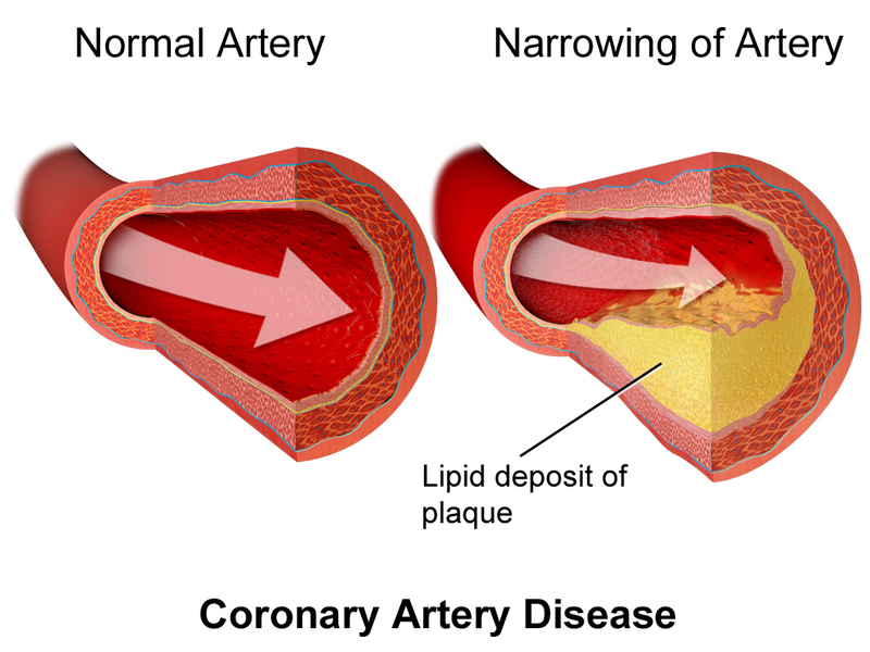Illustration showing a normal artery and a narrowing artery with lipid deposit of plaque