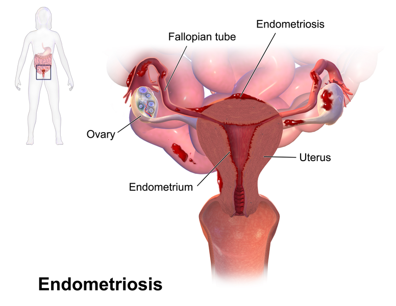 Illustration showing location of endometriosis both on a female figure and as a close up on the female reproductive organs