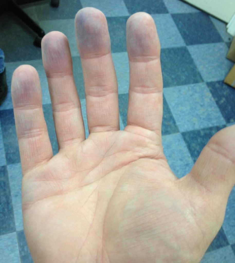 Photo showing a hand with cyanosis on the fingertips
