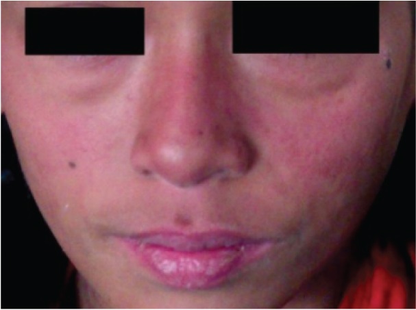 Photo showing a person with a butterfly rash on their face