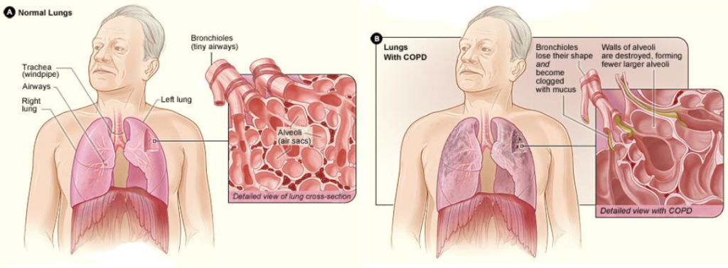 Illustrations comparing normal lungs with C O P D lungs