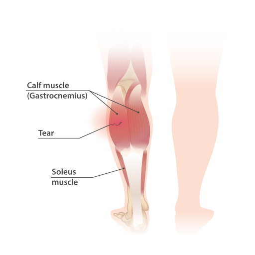 Illustration of strain in calf muscle