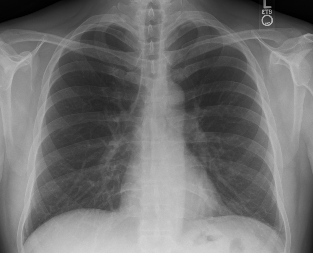 Image showing a Chest X-ray