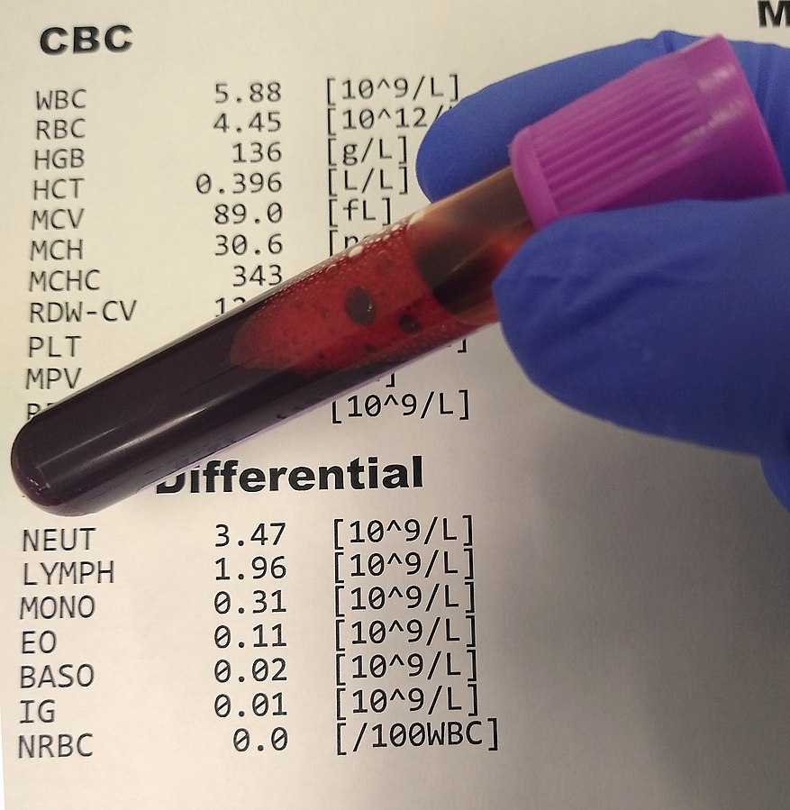 Image showing CBC With Differential Test Results