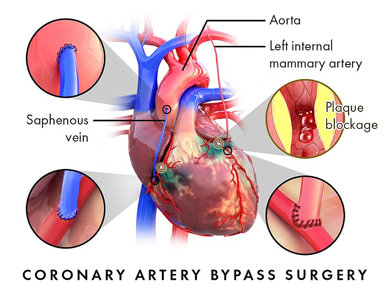 Illustration showing Coronary Artery Bypass Surgery with labels
