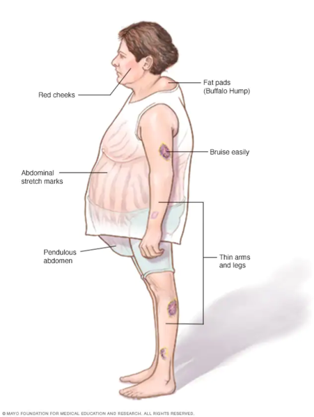 Illustration of woman with Cushing’s Syndrome