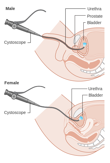 Illustration showing cystoscopy on both a male and a female