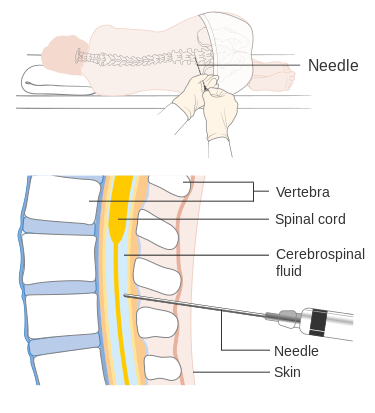 Image showing a lumbar puncture with closeup labeled for major parts